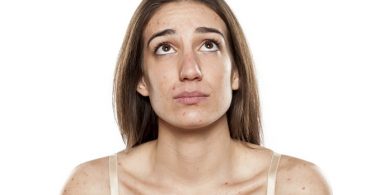 3 Dingen die je Moet Weten Over Acne bij Volwassenen