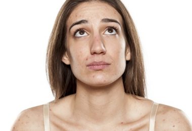 3 Dingen die je Moet Weten Over Acne bij Volwassenen
