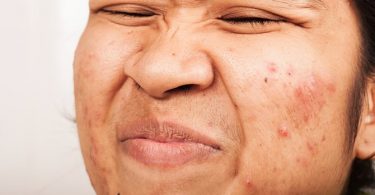 5 Krachtige Anti-Acne Toevoegingen Aan Je Dieet