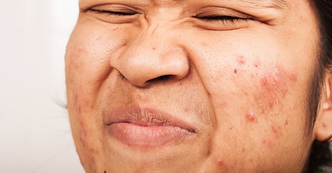 5 Krachtige Anti-Acne Toevoegingen Aan Je Dieet