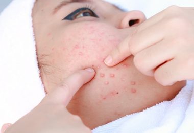 Behandeling van Acne Littekens, Lees Hier Hoe!