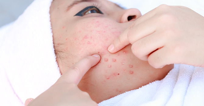 Behandeling van Acne Littekens, Lees Hier Hoe!