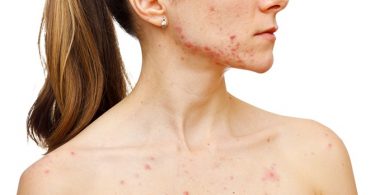 Behandelingen Tegen Acne, Lees Snel Verder!