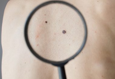Controleren op Vroege Tekenen van Huidkanker