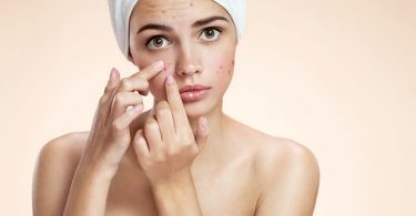 De Beste Tips om Acne Aan te Pakken