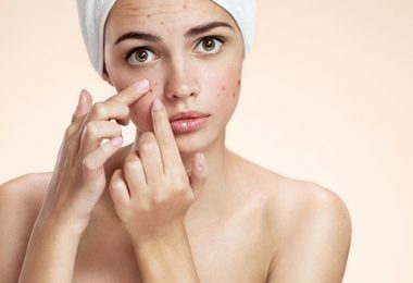 De Beste Tips om Acne Aan te Pakken