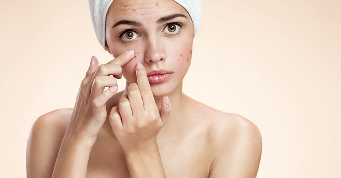 De Beste Tips om Acne Aan te Pakken