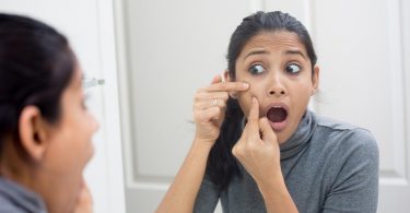 Diverse Opties voor het Verwijderen van Acne Littekens