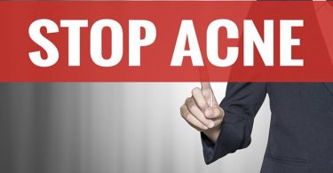 Goed Omgaan met Hardnekkige Acne Littekens