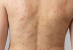 Hoe Kun je Acne op je Rug Voorkomen en Verwijderen