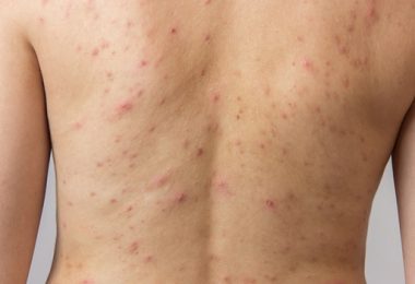 Hoe Kun je Acne op je Rug Voorkomen en Verwijderen