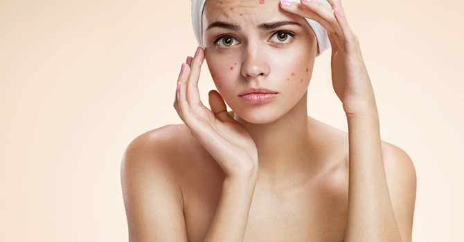Jouw Opties voor de Behandeling van Acne