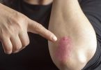 Kan Sporten Uitbraken van Psoriasis Voorkomen?