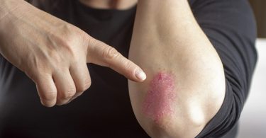 Kan Sporten Uitbraken van Psoriasis Voorkomen?