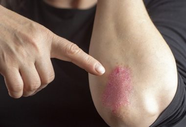 Kan Sporten Uitbraken van Psoriasis Voorkomen?