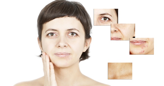 Last van Acne Als Volwassene? Waarom?