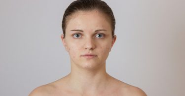 Marokkaanse Arganolie zal je Acne Littekens Verbannen!