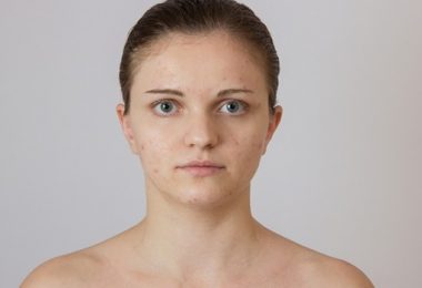 Marokkaanse Arganolie zal je Acne Littekens Verbannen!