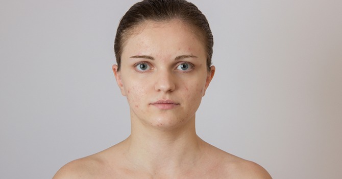Marokkaanse Arganolie zal je Acne Littekens Verbannen!