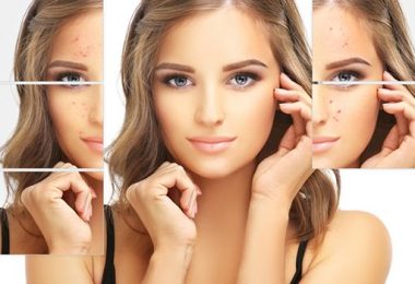 Meer Leren Over Rosacea, Hier alle Informatie!