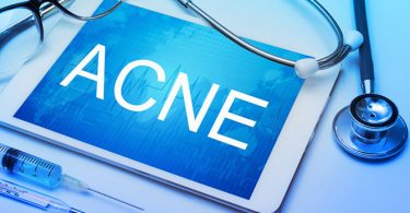 Ongewenste Acne? Lees Hier Hoe Je Dit Voor Kunt Blijven