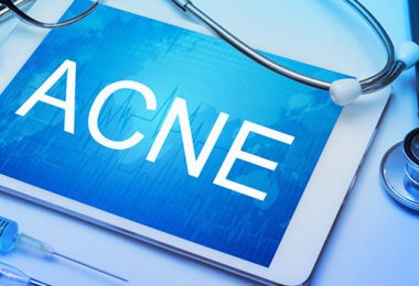 Ongewenste Acne? Lees Hier Hoe Je Dit Voor Kunt Blijven