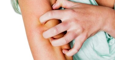 Psoriasis thuis verzorgen! Lees Snel Verder