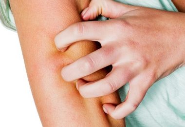 Psoriasis thuis verzorgen! Lees Snel Verder