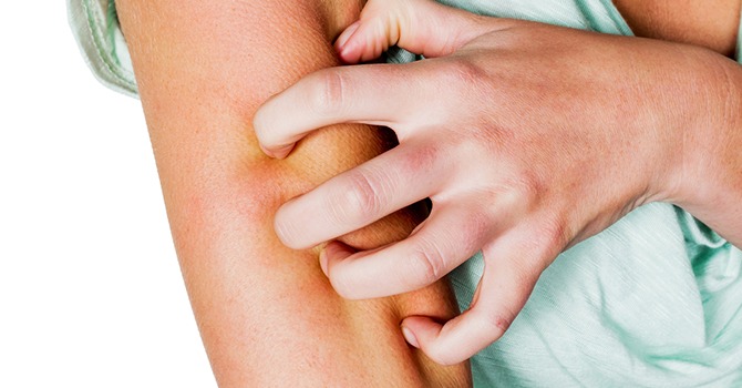 Psoriasis thuis verzorgen! Lees Snel Verder