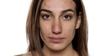 Tips Die Acne Voorkomen En Genezen, Lees Verder!