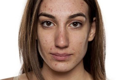 Tips Die Acne Voorkomen En Genezen, Lees Verder!