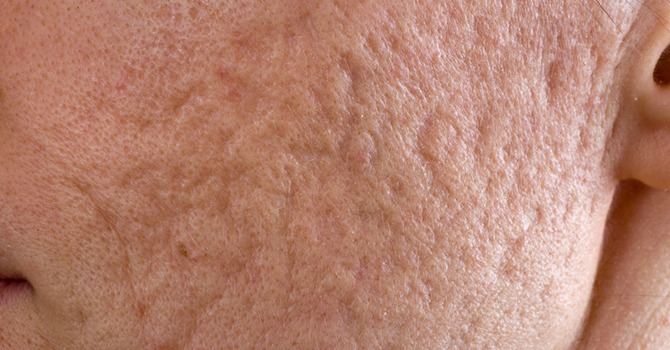 Voorkom dat je de Titel Mr:Mevr Acne Littekens Krijgt!