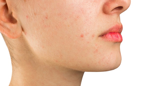 Wat Je Moet Weten en Hoe je Ervan af Komt