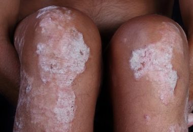 Wat Weet Jij Precies Van Psoriasis?