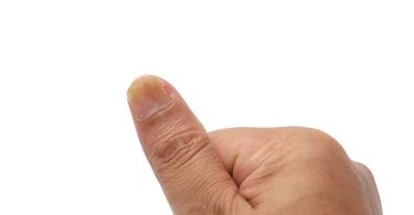 Wat je Moet Weten Over Psoriatische Nagelziekte